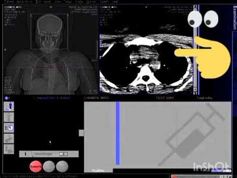 Angiotac Cuello Craneo Siemens Somatom Multidetectores Youtube