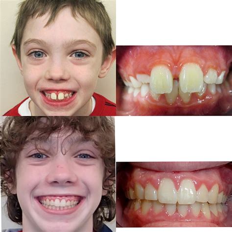 Before And After Braces Wazio Orthodontics