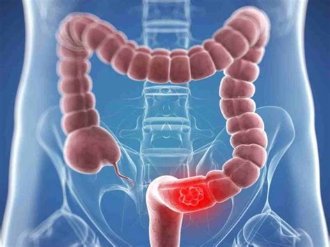 Large Intestine Cancer Symptoms Mehmet Çağlıkülekçi