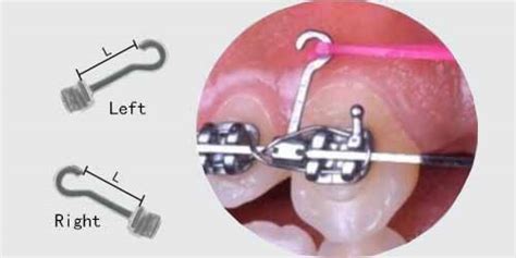 Orthodontic Inside Oral Cavity Crimpable Hook Sliding Ball Crimpable