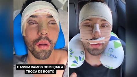 Rico Melquiades Mostra Resultado De Cirurgia Pl Stica E Parece Outra Pessoa