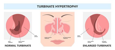 Large Inferior Turbinate: Symptoms, Causes, Diagnosis, and Treatment