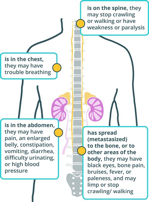 What is Neuroblastoma | Causes & Symptoms