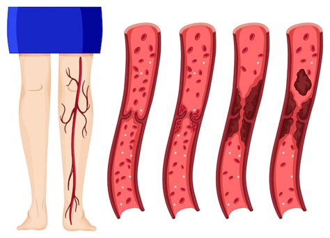 Blood Clot Thigh Early Detection Vectors & Illustrations for Free Download