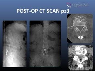 Xlif Ilif Circumferential Arthrodesis As A Minimally Invasive Ppt