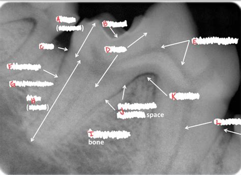 8 Interpretation Of Dental Radiographs Flashcards Quizlet