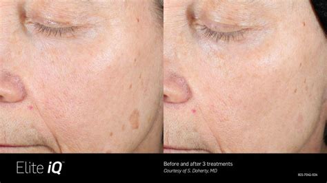 Elite Iq By Cynosure Uses Benefits Pictures And Recovery Derm