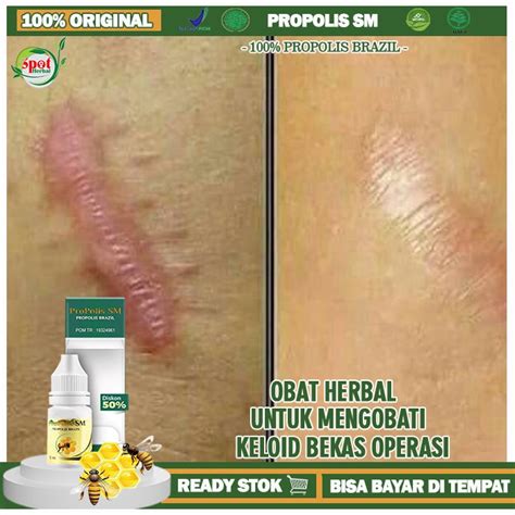 Jual Obat Bekas Luka Operasi Keloid Obat Penghilang Bekas Luka Lama