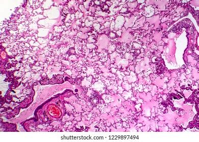 Lung Adenocarcinoma Light Micrograph Photo Under Foto De Stock