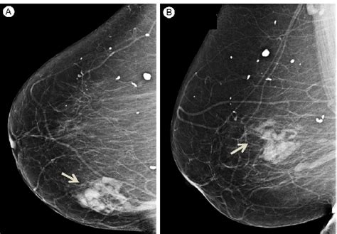 Figure 2 From Sparganosis Existed For More Than Three Years That