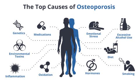 Osteoporosis: Causes, Symptoms and Treatment - Public Health Notes