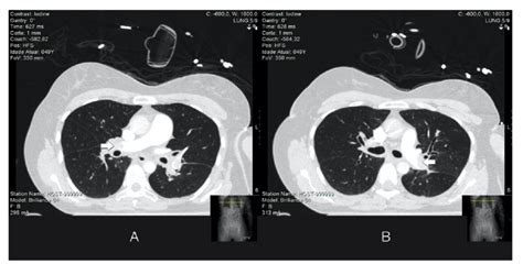 Computed Tomography Pulmonary Angiogram Showing Major Central