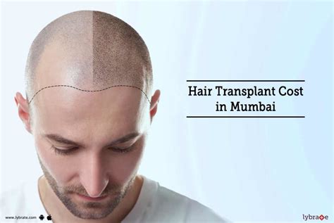 Top 107 Best Hair Transplant In Mumbai Review Polarrunningexpeditions