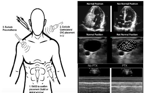 Point Of Care Ultrasound Guided Catheter Confirmation Protocol Image