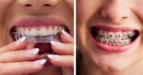 Invisalign Vs Traditional Braces How To Choose Right