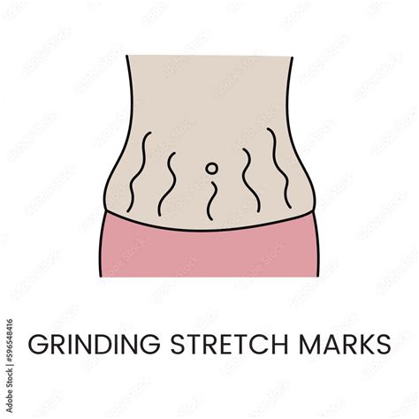 Resurfacing Stretch Marks On The Skin With Laser Cosmetology In Vector