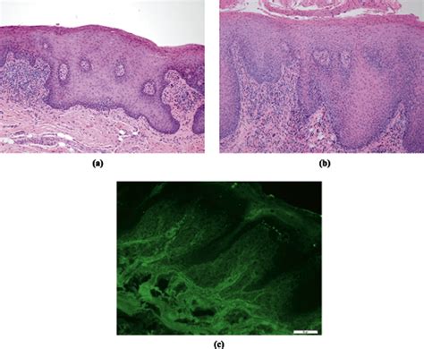 Oral Lichenoid Reactions May Possibly Be Associated With Abatacept A