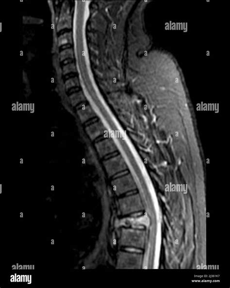 Spinal cancer, MRI scan Stock Photo - Alamy