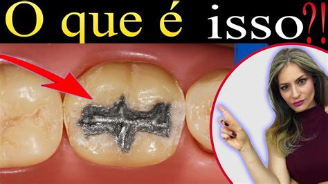 Você Não Sabe O Que é Obturação De Dente Tenho Certeza Youtube