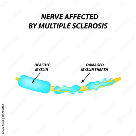 The destruction of the myelin sheath on the axon. Damaged myelin ...