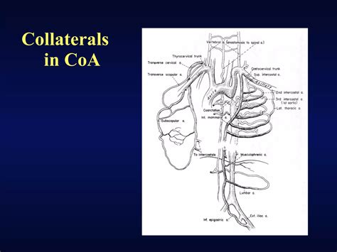 Coarctation Of Aorta Ppt