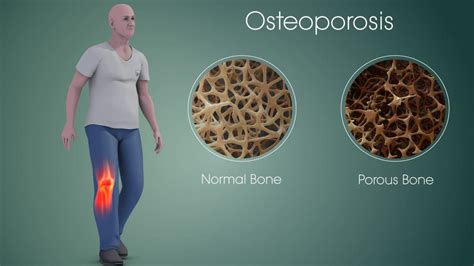 Osteoporosis Symptoms Physical Therapy Treatment And Exercise
