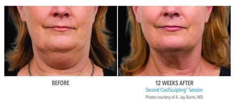 CoolSculpting Face / Neck Before and After Photos NYC