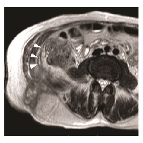 Axial Mr Tse T2 Weighted Scans A C Show The Hydatid Cyst Asterisk