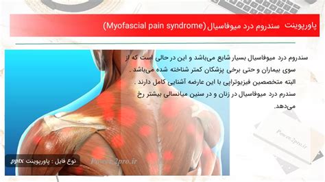 Myofascial Pain Syndrome