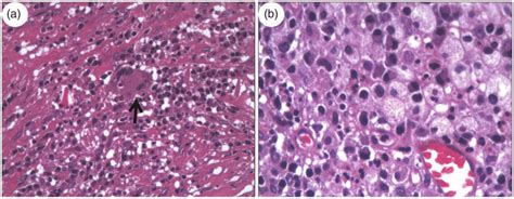 A Photomicrograph Hematoxylin And Eosin Original Magnification