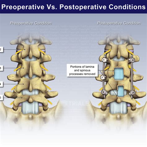 Spondylolytic Spondylolisthesis Trial Exhibits Inc