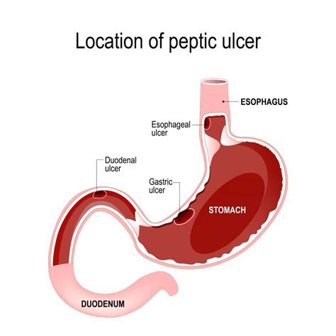 Nausea and Vomiting Singapore - Alpine Surgical | Dr Aaron Poh