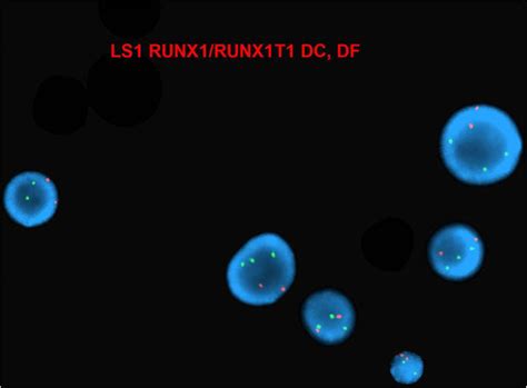 Interphase Fish With Runx Runxt Dual Color Dual Fusion Probe Showed