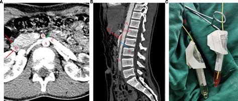 Nutcracker Syndrome Ultrasound