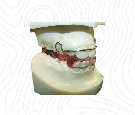 Bionator Appliance Orthodontic Retainers And Other Appliances