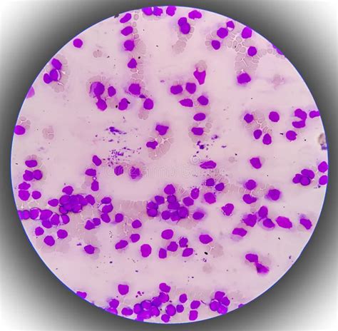 Acute Myeloid Leukemia Aml Smear Show Monocytes And Mostly Blast