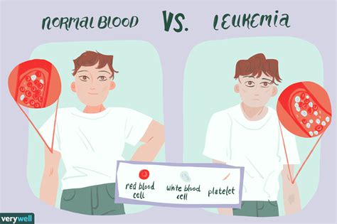 Leukemia Overview And More