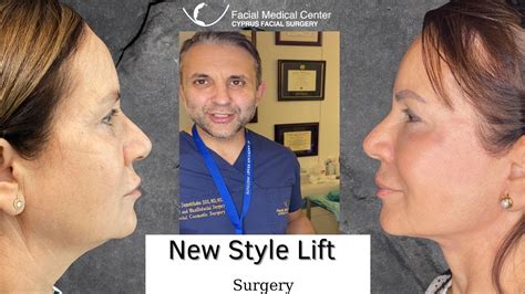 New Style Lift Cyprus Facial Surgery Youtube