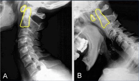 Atlanto Axialsubluxation