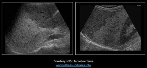 Wk 2 Liver Pathology Fatty Infiltration With Images Ultrasound