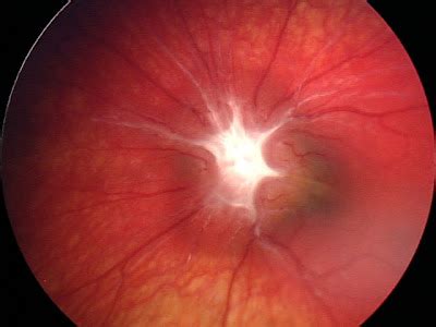 Pediatric Retina: Elevated Optic Nerve in 16-month old