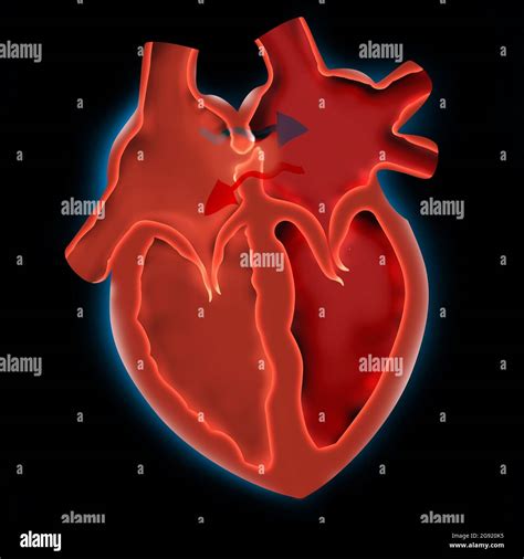 Foramen Oval Permeable Fop Agujero En El Coraz N Fotograf A De Stock