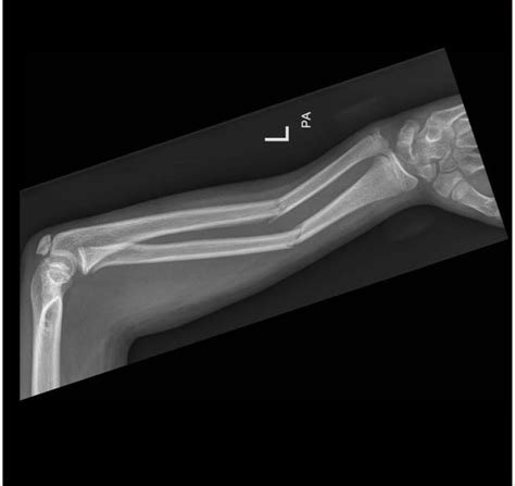 Radius and Ulna fracture : r/Radiology