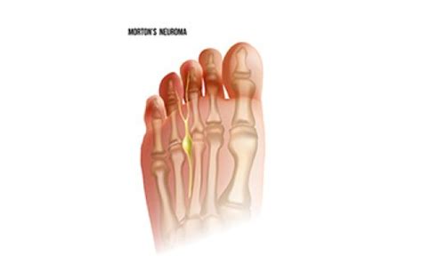 Common Symptoms of Morton's Neuroma - Blog