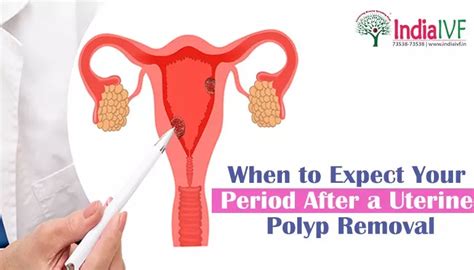 When to Expect your Period after a Uterine Polyp Removal