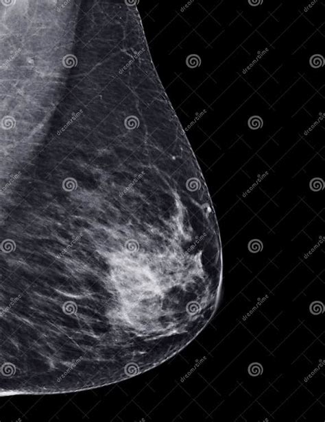 X Ray Digital Mammogram Or Mammography Of Both Side Breast Standard