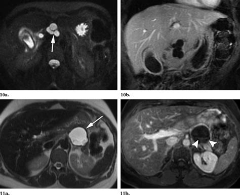 11 Mucinous Cystadenoma 10a Axial T2 Weighted Fat Saturated Mr