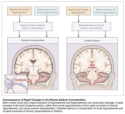 Diagnosis And Management Of Hyponatremia Recapem