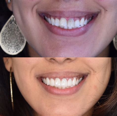 Before And After Veneers Procedure Dr Christian Chung D D S