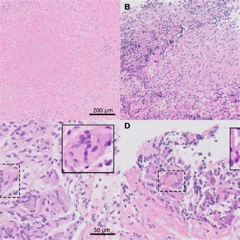 Histopathology Of Biopsy Specimens Images All Show Hematoxylin And